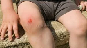 Hydrogen peroxide for MRSA, Impetigo, gum disease, gut issues and more!